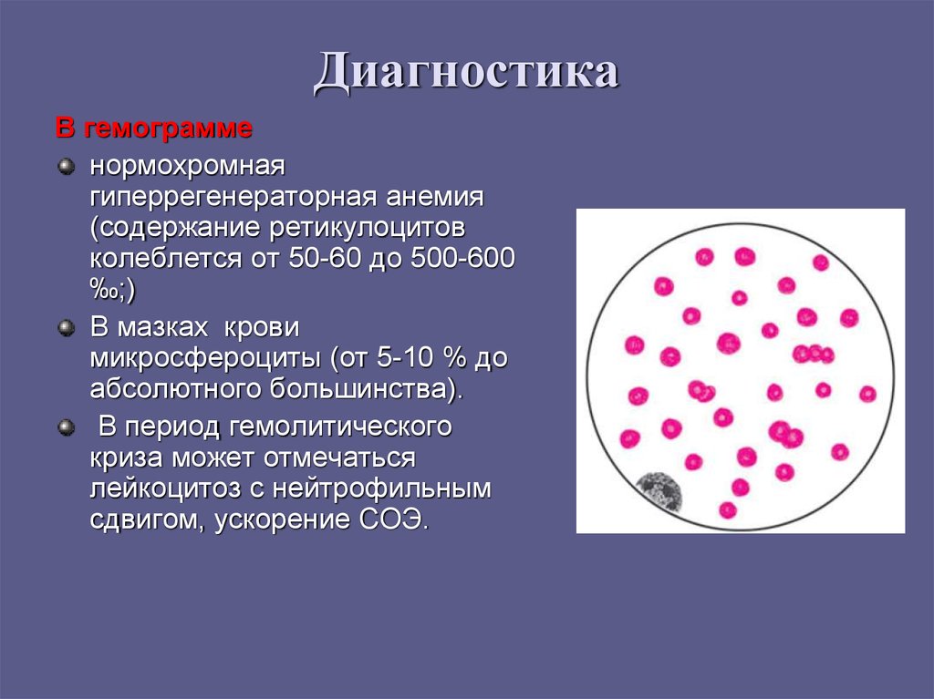 Лейкоцитоз тромбоцитопения. Постгеморрагическая анемия ретикулоциты. Содержание ретикулоцитов при различных анемиях.. Ретикулоциты анализ крови анемия. Нормохромная гиперрегенераторная микроцитарная анемия.