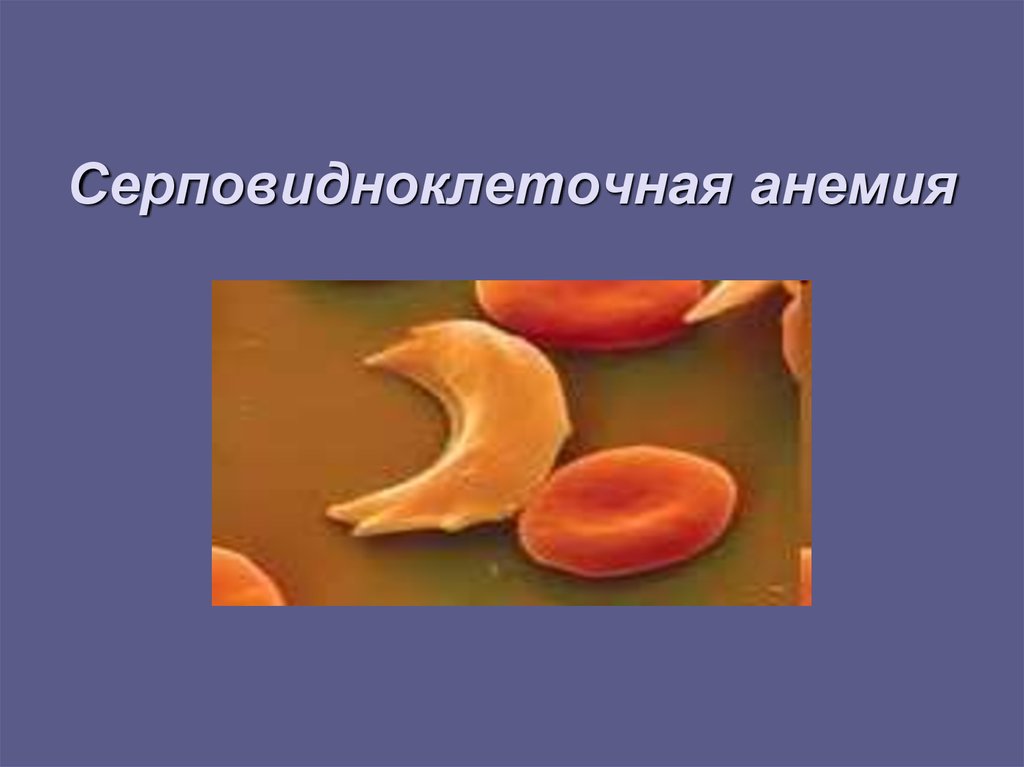 Серповидно клеточная анемия признаки