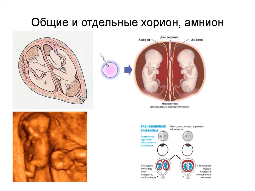 Хорион это. Амнион бластомер хорион. Близнецы раздельный амнион хорион плацента. Хорион амниотическая оболочка. Амнион и хорион.