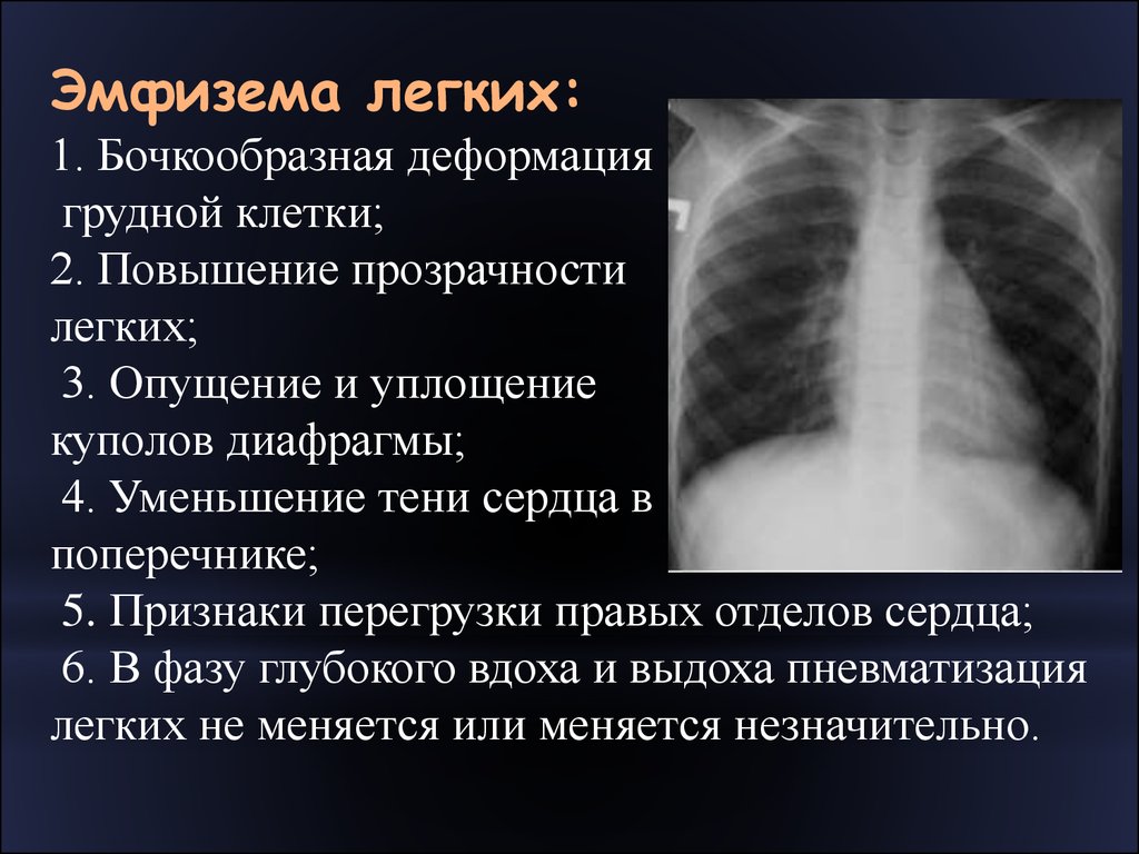 Симптомы грудная клетка. Рентгенография органов грудной клетки ХОБЛ. Признаки эмфиземы легких на рентгене. Эмфизема рентген описание. Рентгенологические признаки эмфиземы легких.