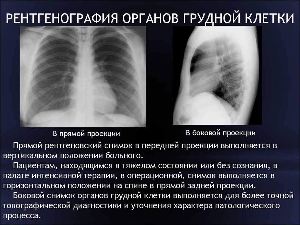 Рентгенография грудной. Рентген грудной клетки в боковой проекции норма. Рентгеноскопия органов грудной клетки в норме. Рентгенография грудной клетки (в 1-й проекции). Рентген ОГК В прямой проекции.