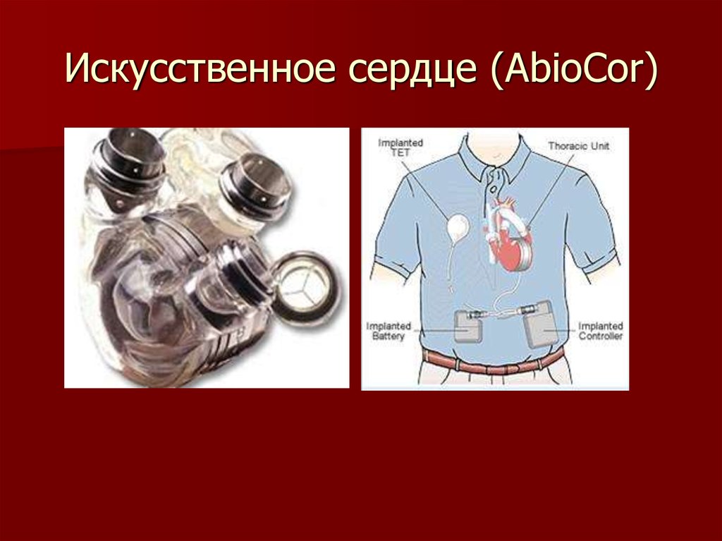 Искусственное сердце. Автономное искусственное сердце abiocor. 3. Искусственное сердце abiocor (2001). 1. Искусственное сердце abiocor. Аппарат искусственного сердца abiocor.