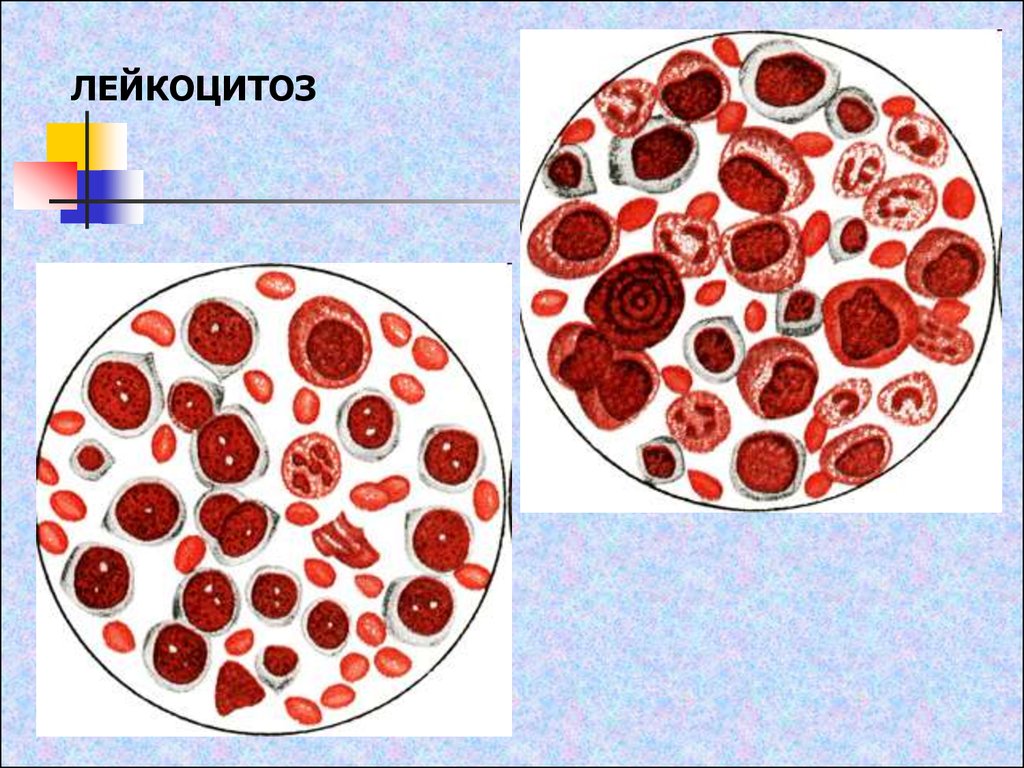 Лейкоцитоз и лейкопения