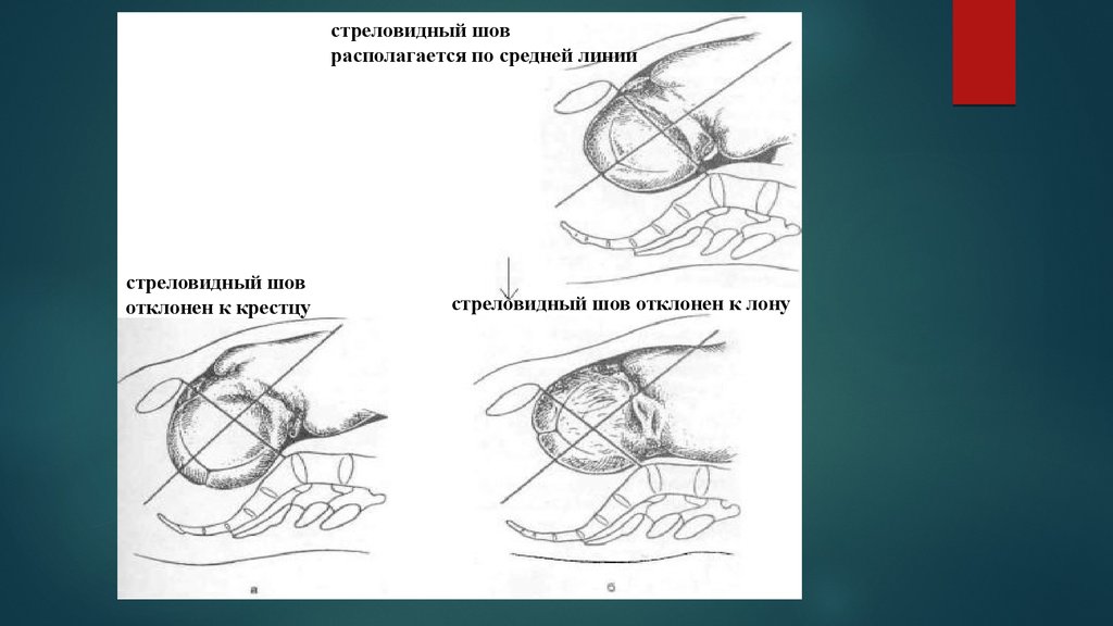 Стреловидный шов фото