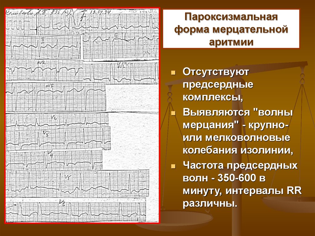 Ибс пароксизмальная форма фибрилляции предсердий карта вызова