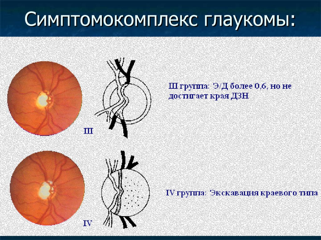 Норма зрительного нерва. Экскавация диска зрительного нерва норма. Экскавация диска зрительного нерва при глаукоме. Физиологическая экскавация ДЗН. Экскавация глазного дна.