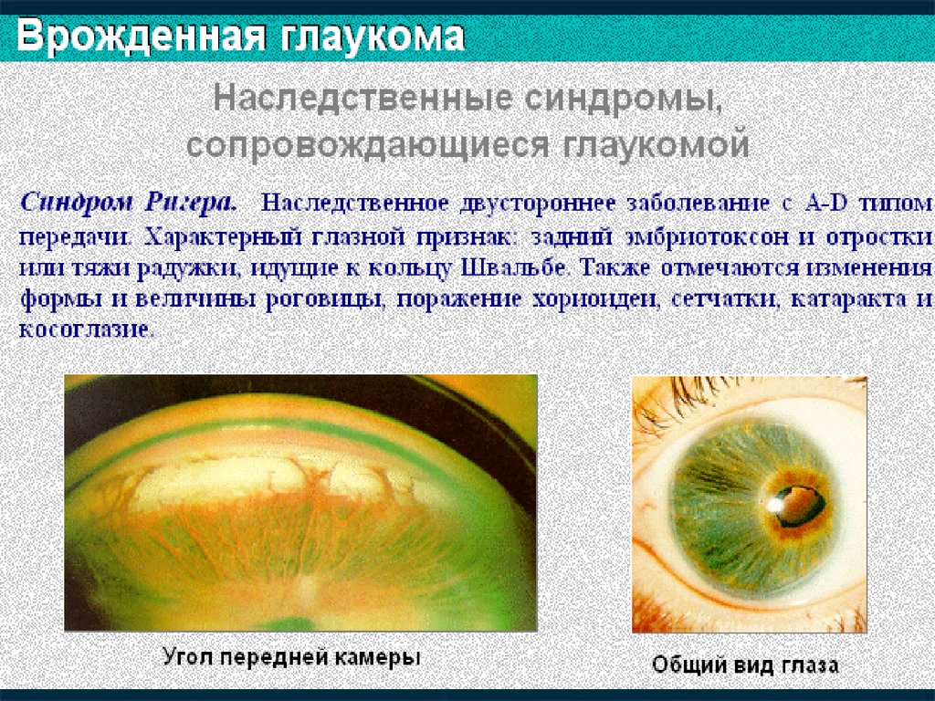 Глаукома латынь