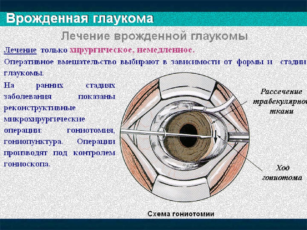 Схема лечения глаукомы