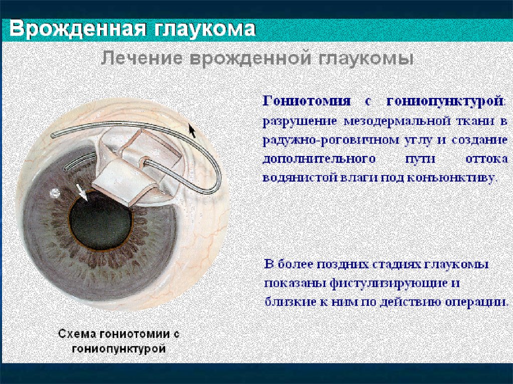 При глаукоме можно применять. Врожденная глаукома патогенез. Врожденная глаукома лечение. Причины развития врожденной глаукомы. Врожденная глаукома операция.