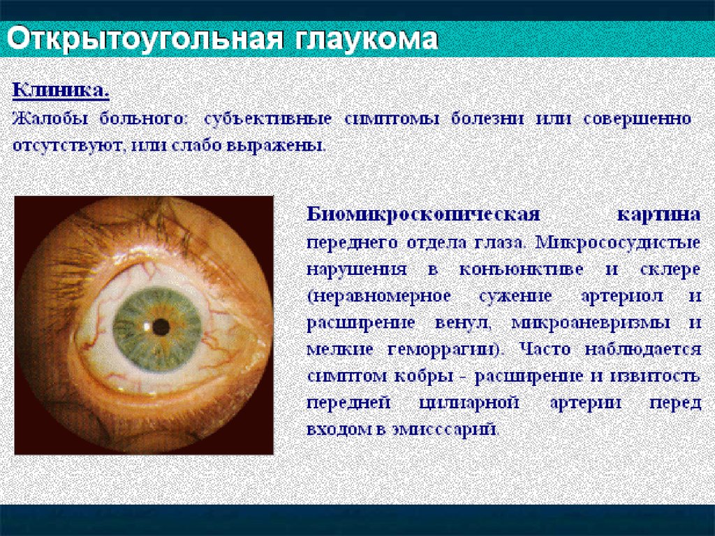 Для открытоугольной глаукомы характерны тест. Первичная открытоугольная глаукома. Симптомы открытоугольной глаукомы. Закрытоугольная глаукома патанатомия. Причины первичной глаукомы.