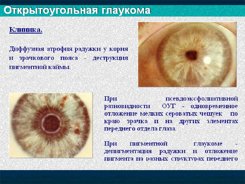 Для открытоугольной глаукомы характерны тест. Симптомы открытоугольной глаукомы. Клиника открытоугольной глаукомы. Клиника открыто угольнольной глаукомы.