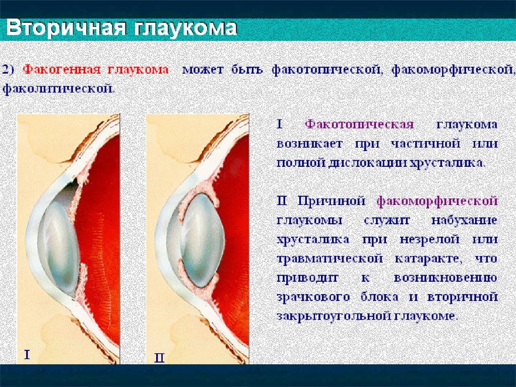 Глаукома латынь. Вторичная открытоугольная глаукома. Факотопическая глаукома. Первичная закрытоугольная глаукома.