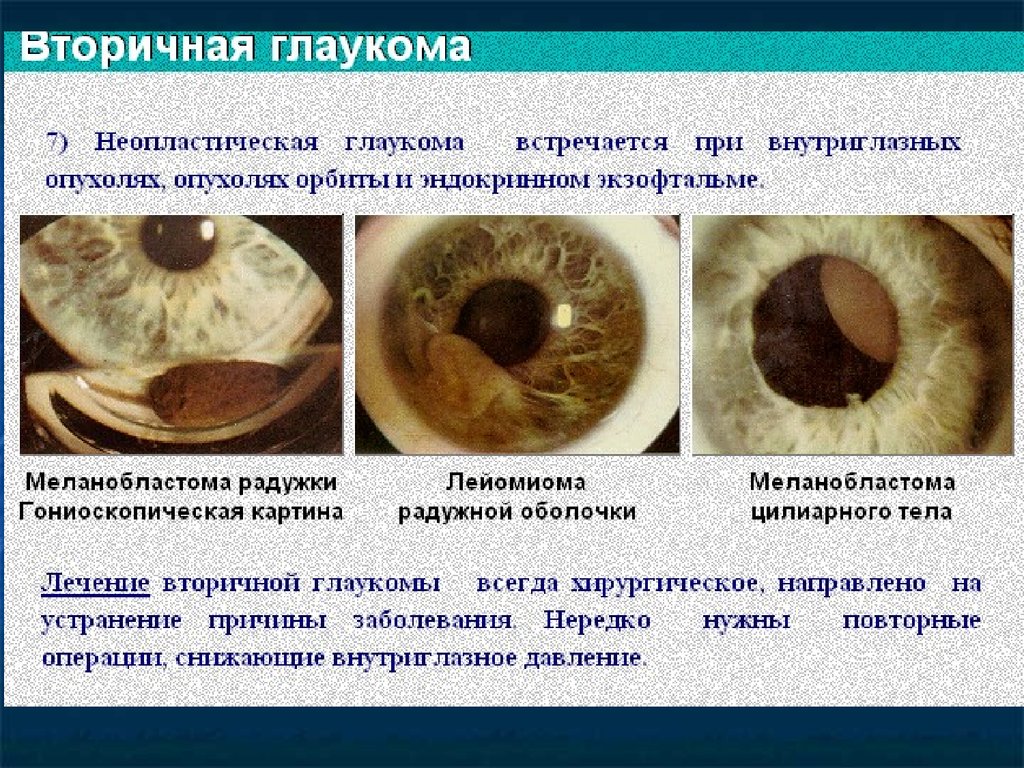 Классификация глаукомы. Вторичная факолитическая глаукома. Неопластическая глаукома. Причины послевоспалительной вторичной глаукомы.