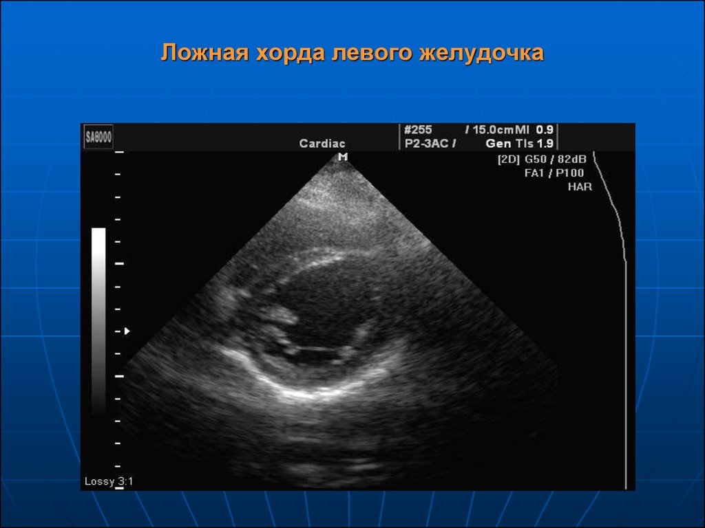 Хорда левого желудочка. ЭХОКГ ложная хорда. Эхокардиография сердца ложная хорда. Ложная хорда левого желудочк. Дополнительная хорда в левом желудочке сердца.