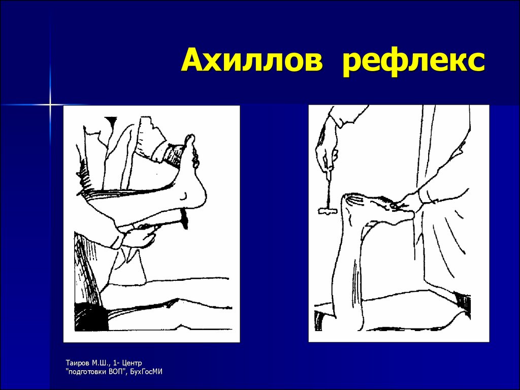 Схема рефлекторной дуги ахиллова рефлекса