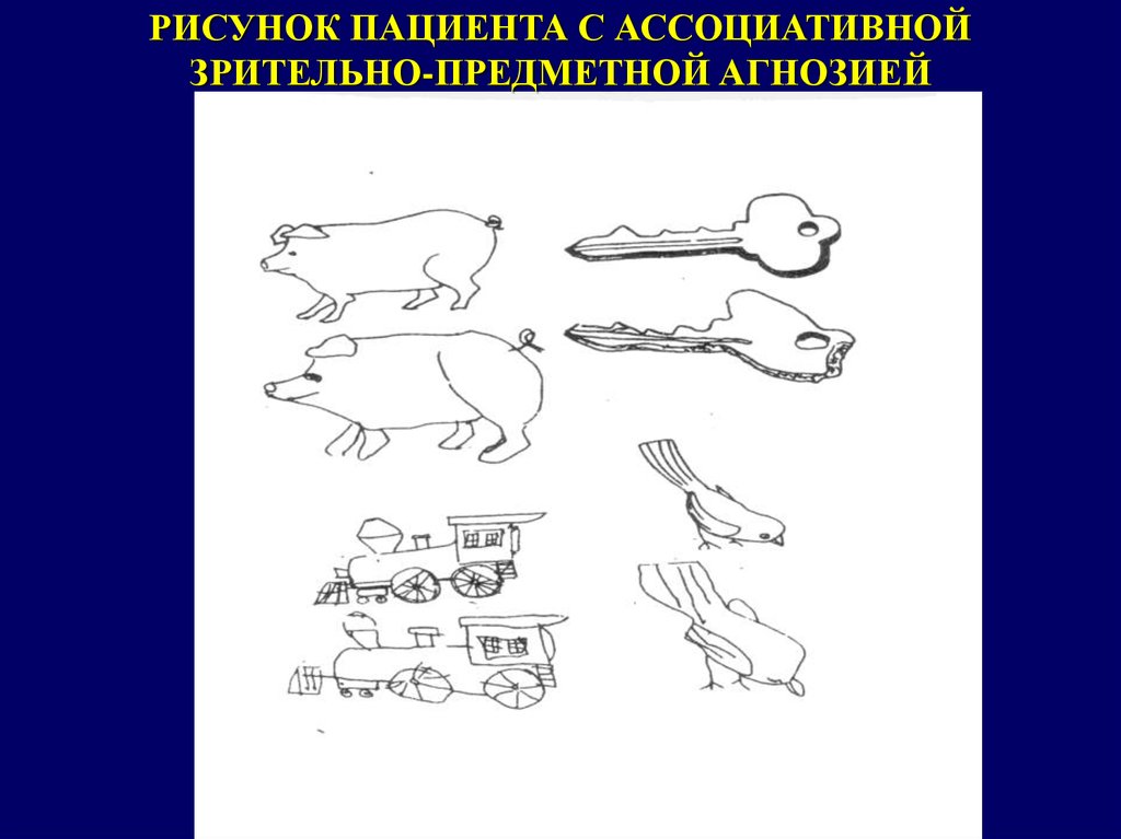 1 схему рисунок отражающие нарушения зрительного внимания игнорировании какой либо стороны