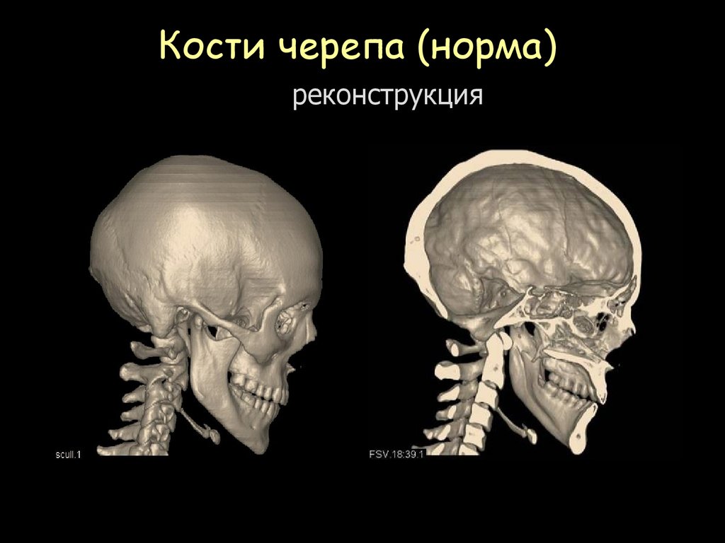 Толщина кости. Реконструкция костей черепа. Толщина черепа человека.