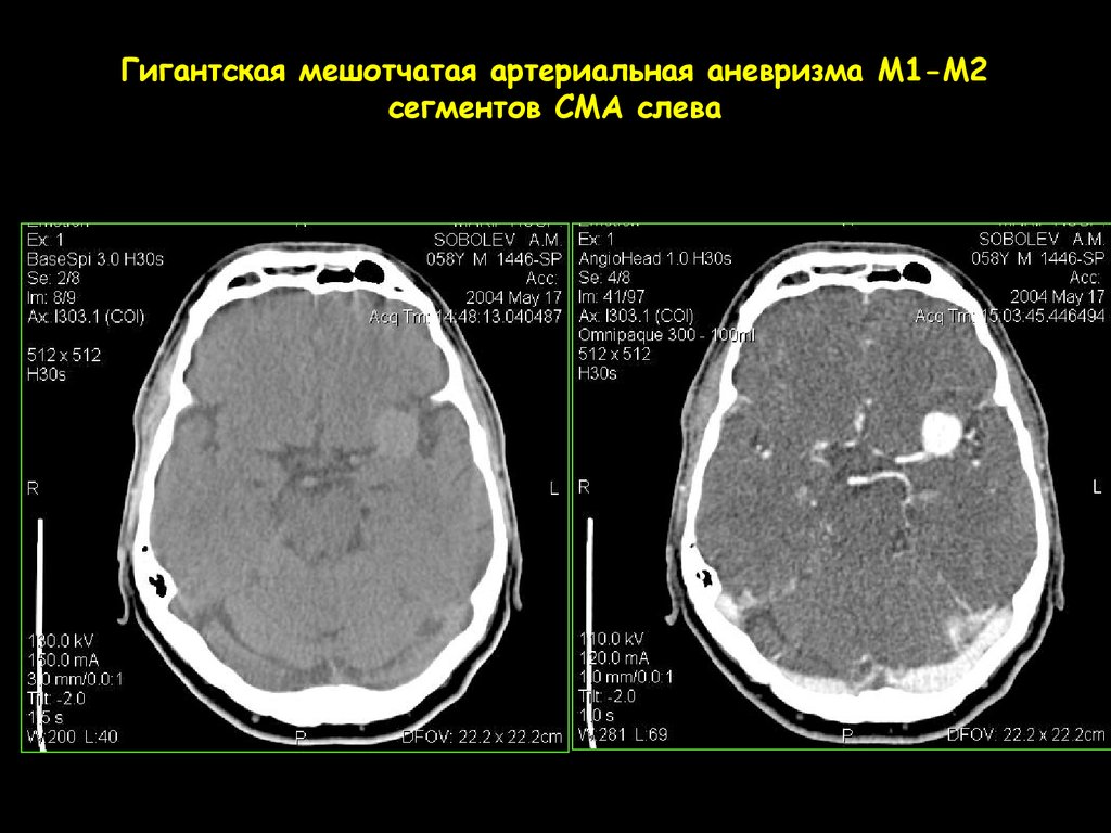 2 сегмент. М1 сегмент средней мозговой артерии мрт. Аневризма м1 сегмента СМА. Аневризмы левой СМА ( сегмент м1). М2 сегмент СМА на кт.