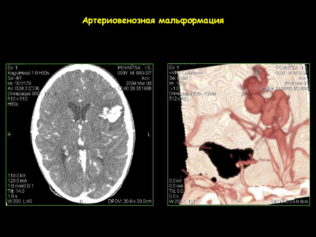 Венозная мальформация. Артериовенозные мальформации (АВМ) головного мозга.. Атриовентрикулярная мальформация. Артериовенозные мальформации головного мозга кт. Артериовенозная мальформация сосудов головного мозга гистология.