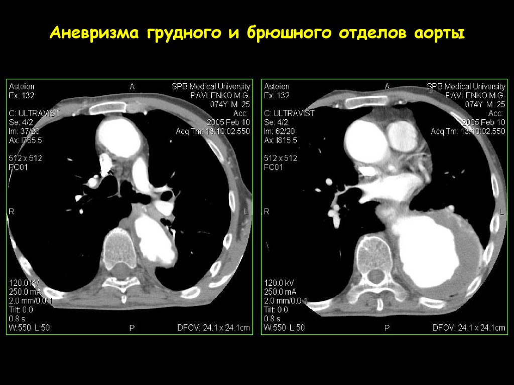 Диагностика аорты