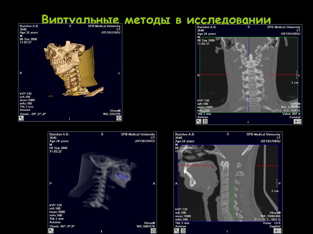 Виртуальные методы c. Эксцентричное расположение в рентгенологии. Virtual method.