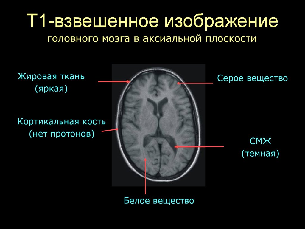 Взвешенное изображение мрт что это