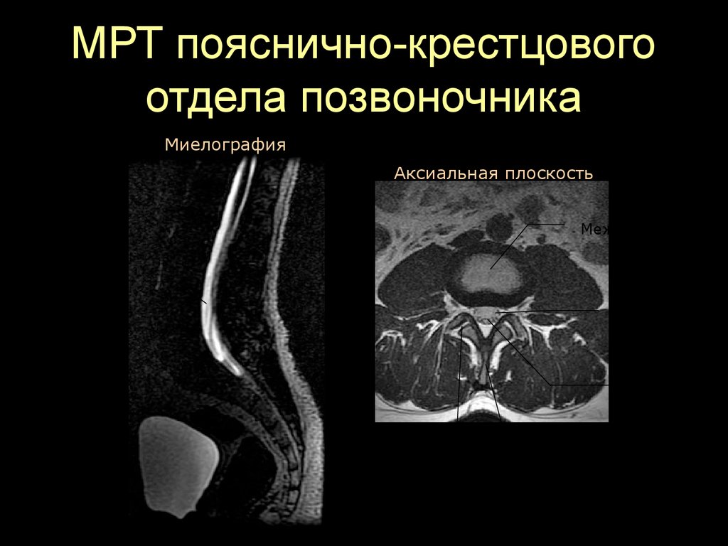 Мрт крестцово поясничного. Аксиальная мрт позвонка. Пояснично-крестцовый отдел позвоночника + миелография. Позвоночник мрт аксиальный. Анатомия поясничного позвонка мрт.