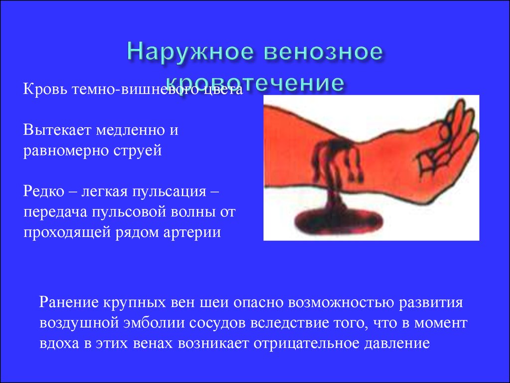 Первая помощь при венозном. Наружное венозное кровотечение. Наружное венозное кровотечение цвет. При наружном венозном кровотечении. Характерные признаки венозного кровотечения.