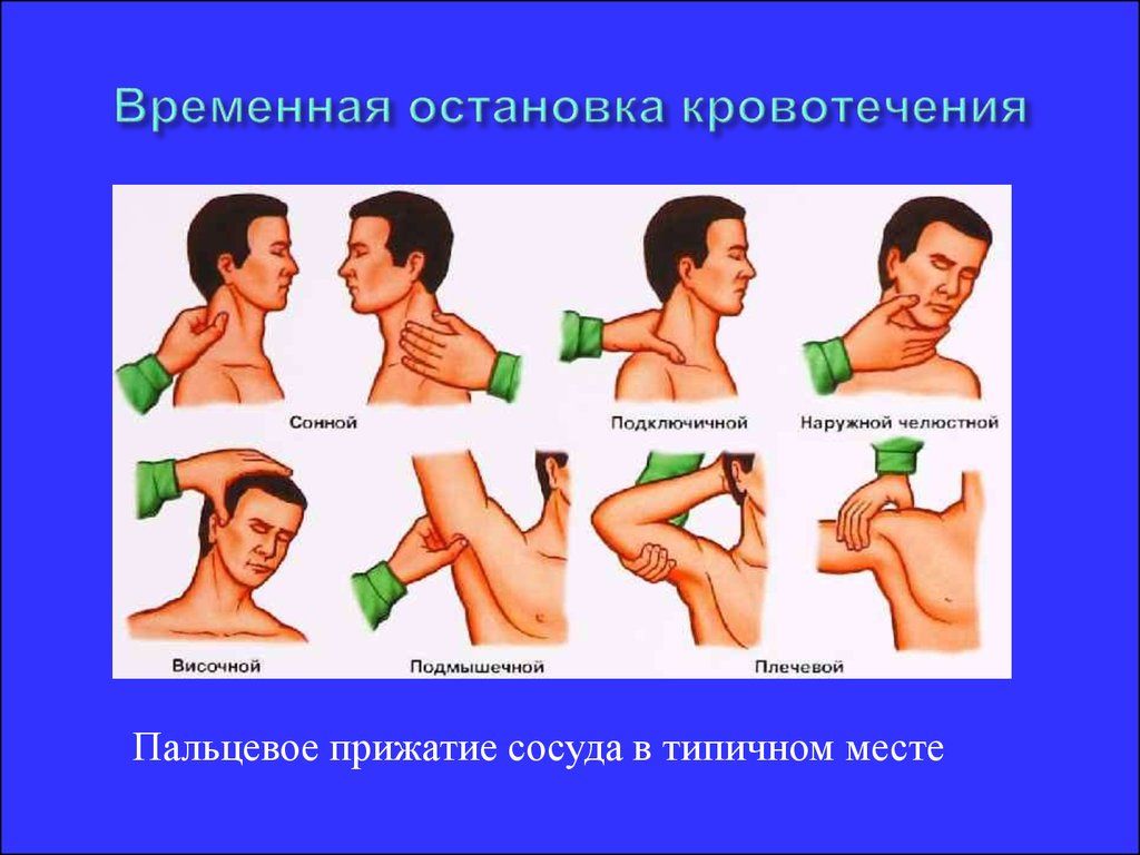 Временной остановки. Способы остановки наружного кровотечения. Временные методы остановки кровотечения. Методы временной остановки наружного кровотечения. Время остановки кровотечения.