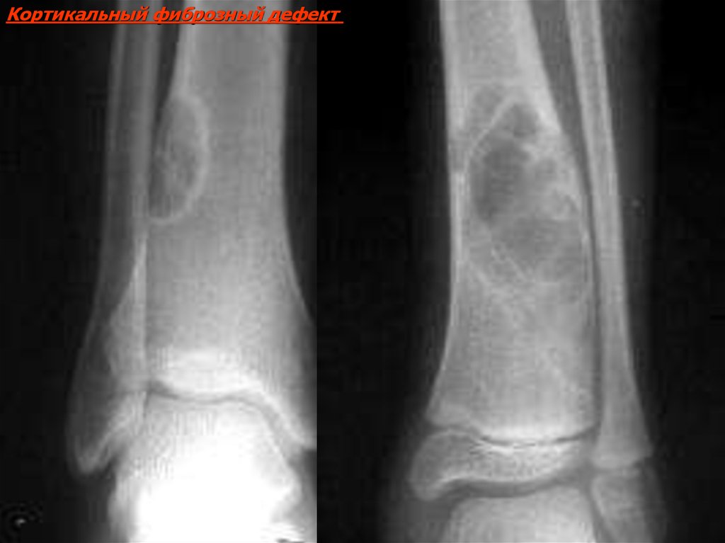 Фиброзная кость. Неоссифицирующая фиброма большеберцовой кости. Опухоли малоберцовой кости рентген. Неоссифицирующая фиброма рентген. Фиброзная дисплазия большеберцовой кости кт.