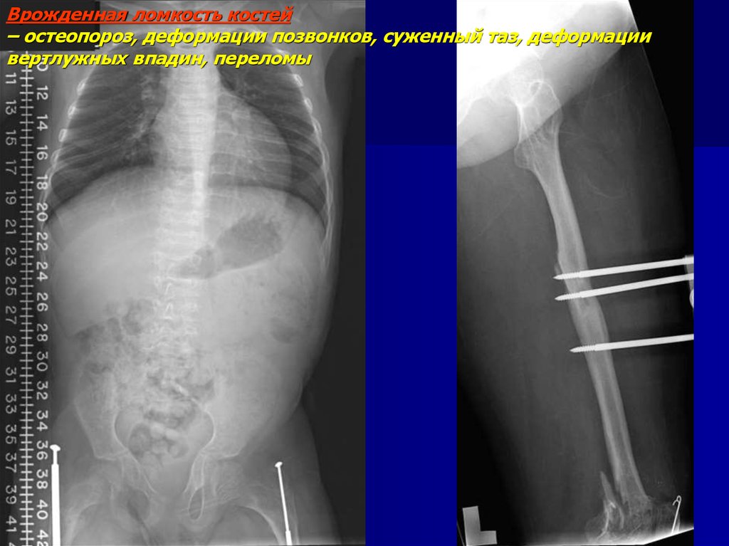 Нарушение развития костей. Остеопороз несовершенный остеогенез. Врожденные нарушения b2. Заболевания и нарушения врожденные костей и суставов картинки.