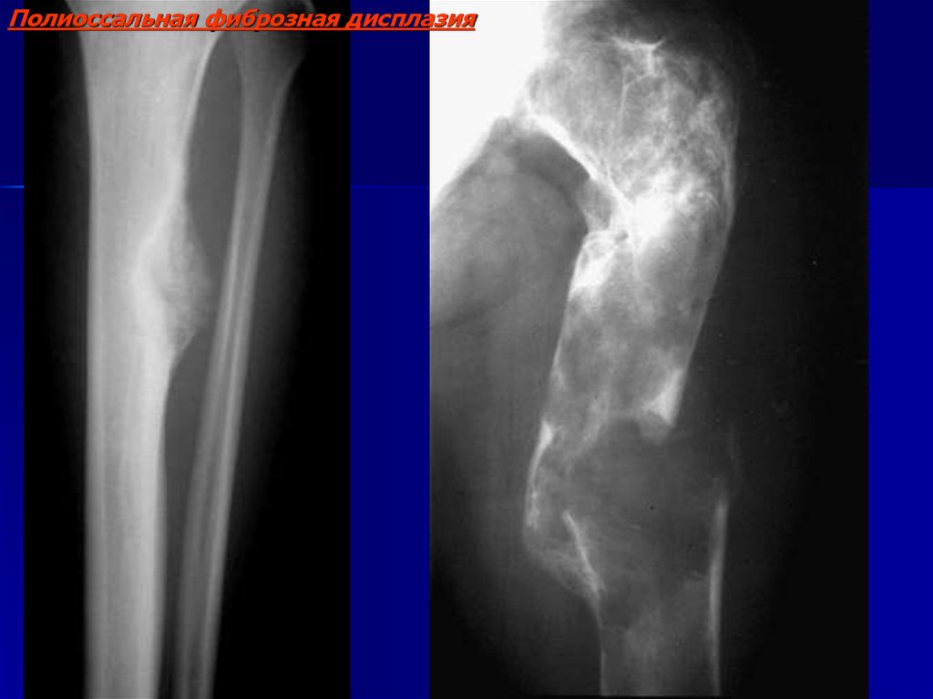 Фиброзная дисплазия. Полиоссальная фиброзная дисплазия. Монооссальная фиброзная дисплазия. Полиастазная фибрлзная диплазия. Фиброзная дисплазия кости рентген.