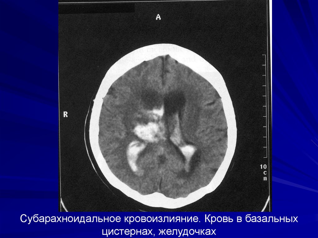 Кровоизлияние желудочка. Субарахноидально-вентрикулярное кровоизлияние. Базальное субарахноидальное кровоизлияние. Субарахноидальное кровоизлияние в базальных цистернах. Субарахноидальное кровоизлияние с прорывом в желудочковую систему.