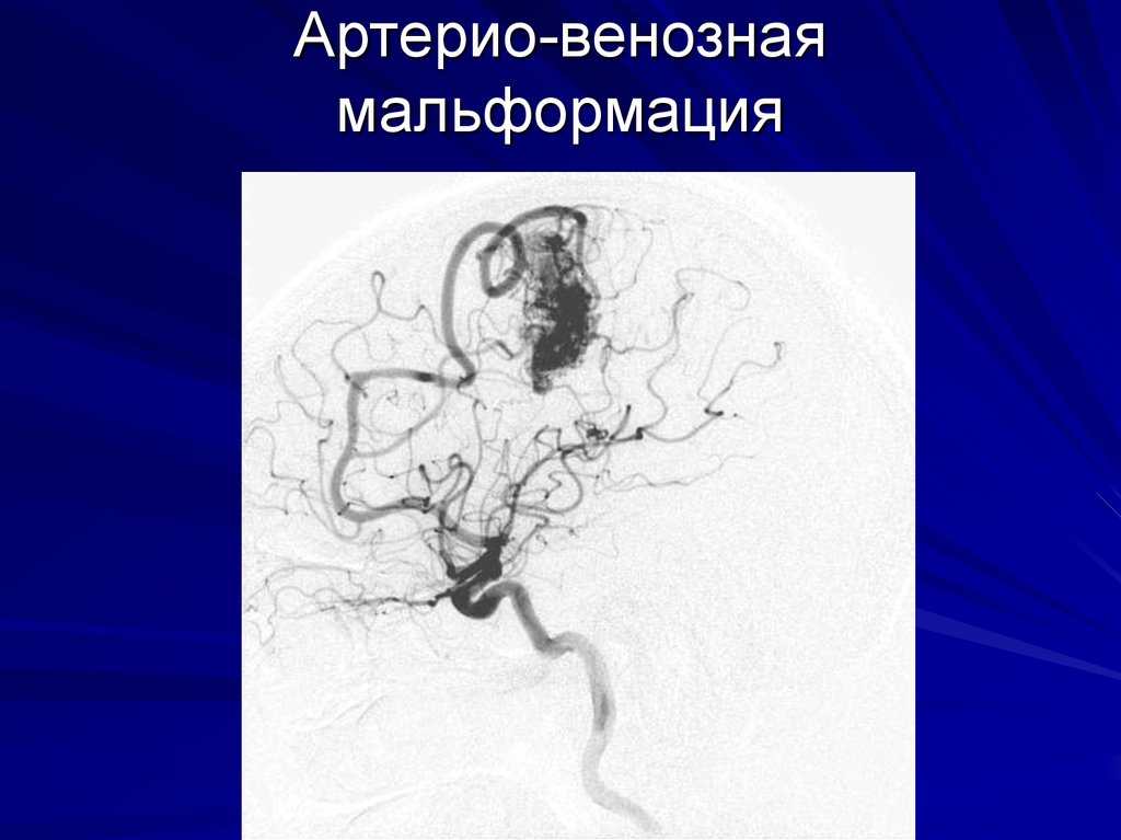 Венозная мальформация. Венозная мальформация руки. Венозная мальформация на коже. Структуру артерио-венозной мальформации. Сосудистые мальформации у детей.