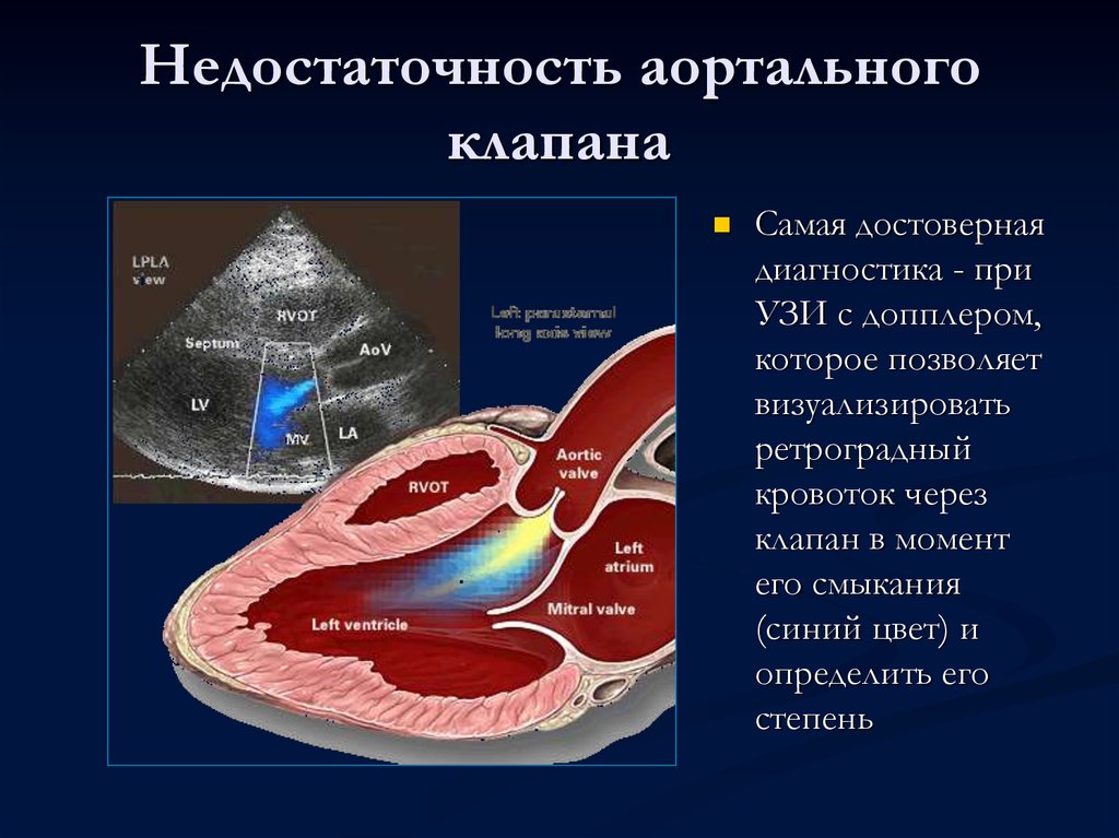 Парапротезная регургитация аортального клапана