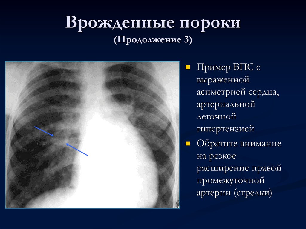 Дилатация правых отделов. Рентгенодиагностика врожденных пороков сердца. Пороки сердца с легочной гипертензией. Врожденный порок сердца рентген.