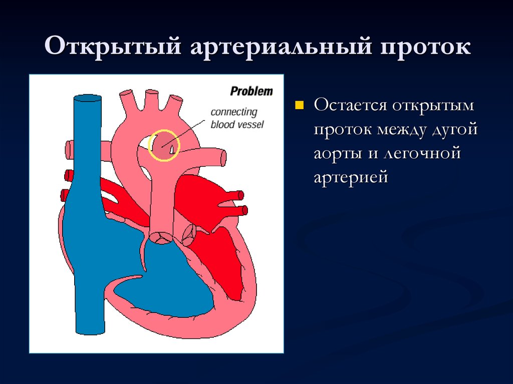 Оап у новорожденных. Врожденный порок сердца открытый артериальный проток. Открытый артериальный проток Баталов. Порок открытый боталлов проток. ВПС открытый боталлов проток.