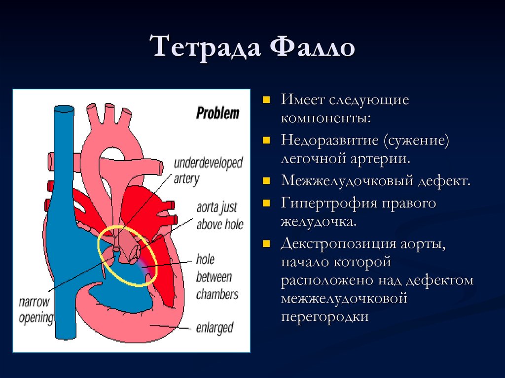 Тетрада фалло