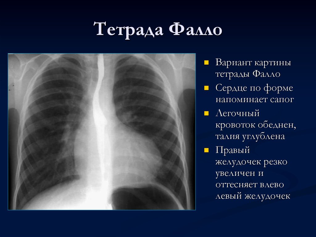 Тетрада фалло это. Рентген при Тетрада Фалло. Рентгенологические признаки тетрады Фалло. Врожденный порок сердца рентген. Рентген при тетраде Фалло у детей.