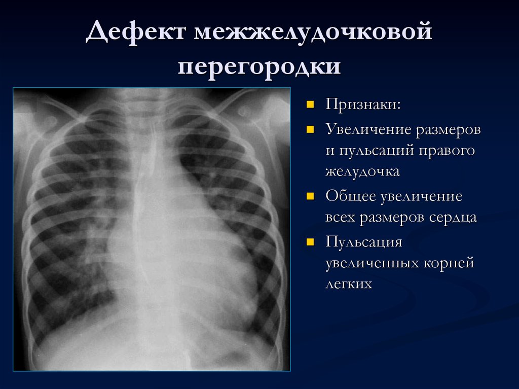 Дефекты перегородок. ДМЖП рентгенологические признаки. Дефект межжелудочковой перегородки рентген. Пороки сердца на рентгенограмме.