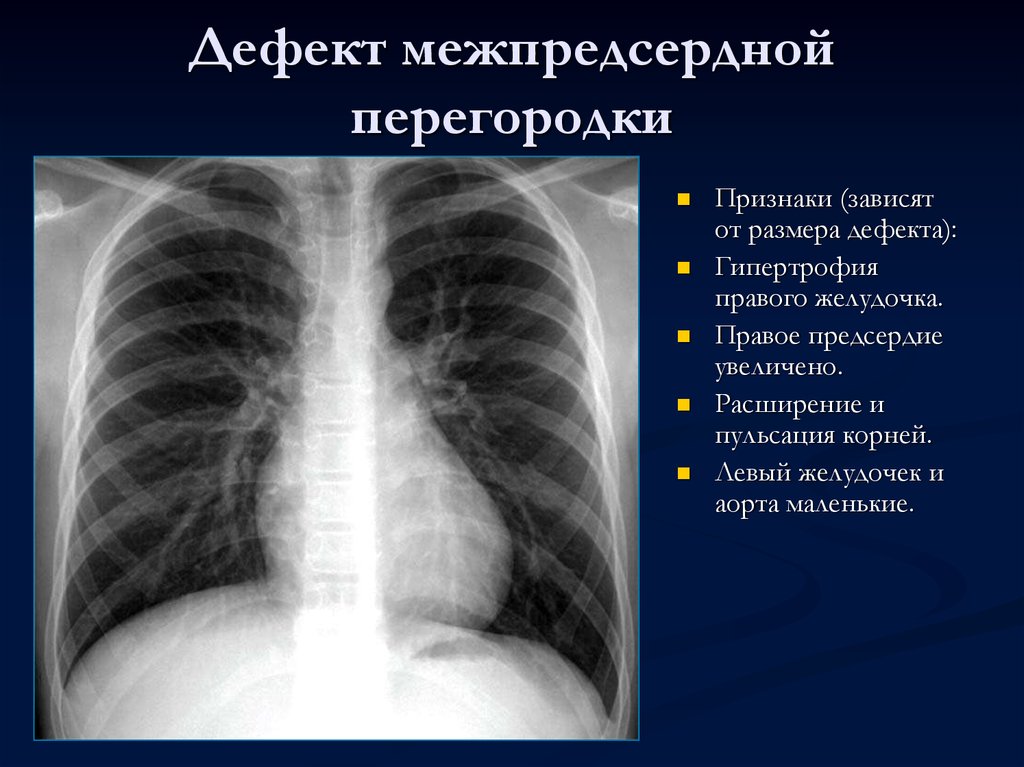 Дефект межпредсердной. Гипертрофия левого предсердия рентген. Расширение правого желудочка сердца рентген. Дефект межпредсердной перегородки симптомы. Гипертрофия правого желудочка рентген.