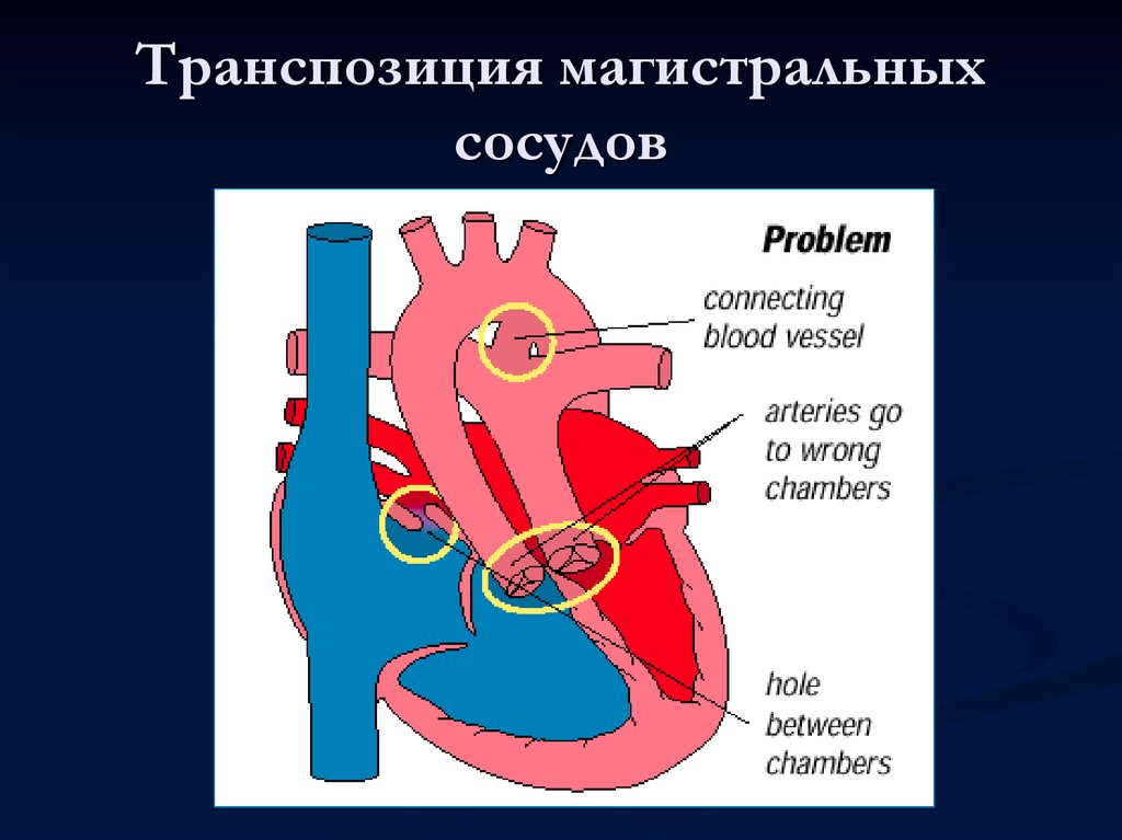 Магистральные сосуды это. Врожденный порок сердца транспозиция магистральных артерий. ТМС порок сердца гемодинамика. Порок сердца транспозиция магистральных сосудов. Транспозиция легочной артерии.