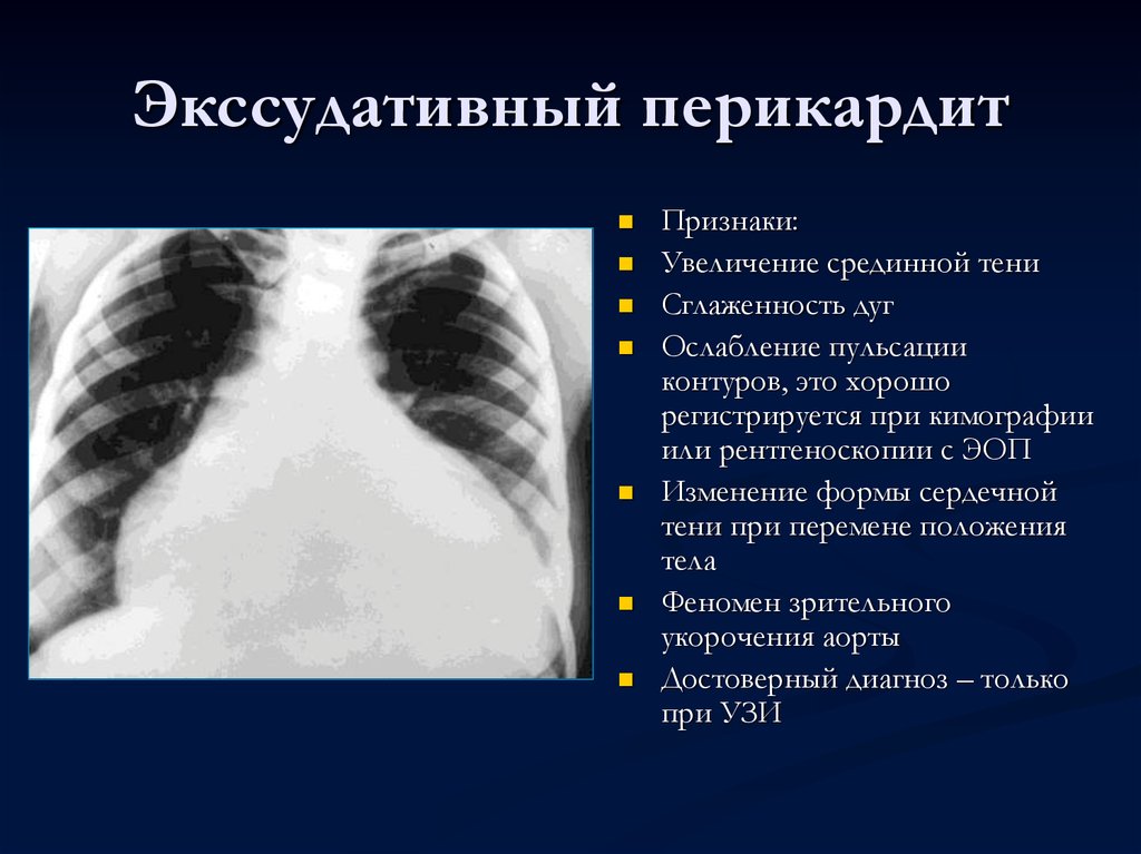 Выпотной перикардит. Рентгенограмма при экссудативном перикардите. Экссудативный перикардит рентген. Рентгенологический признак выпотного перикардита:. Перикардит рентген признаки.