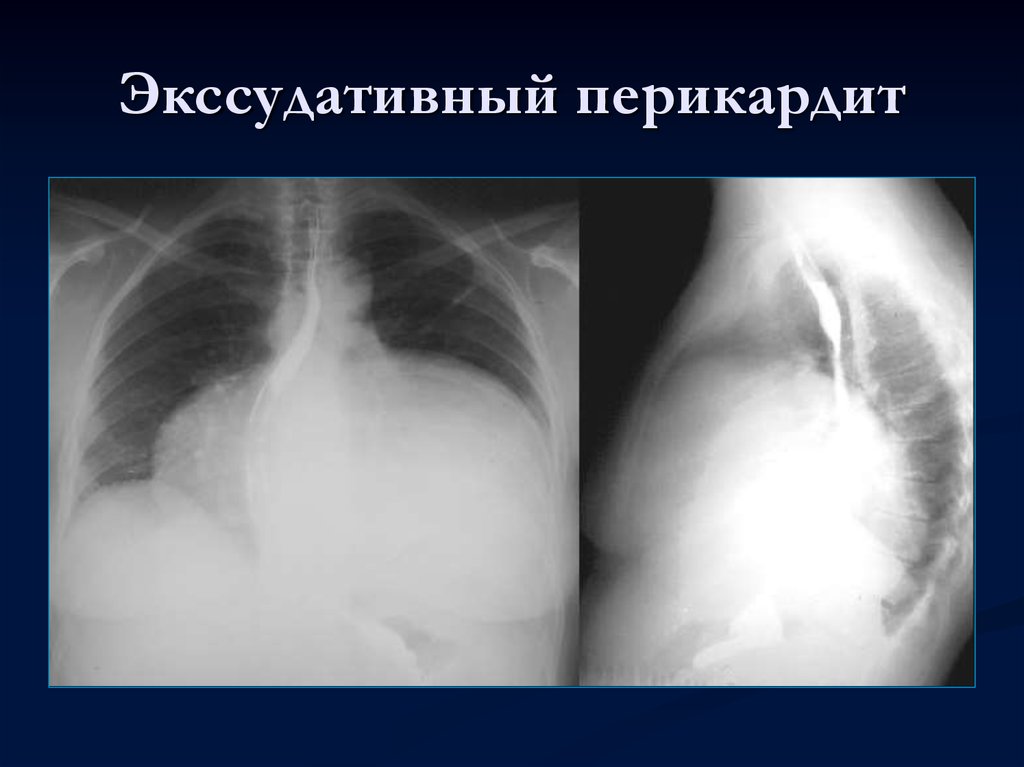 Туберкулезный перикардит презентация