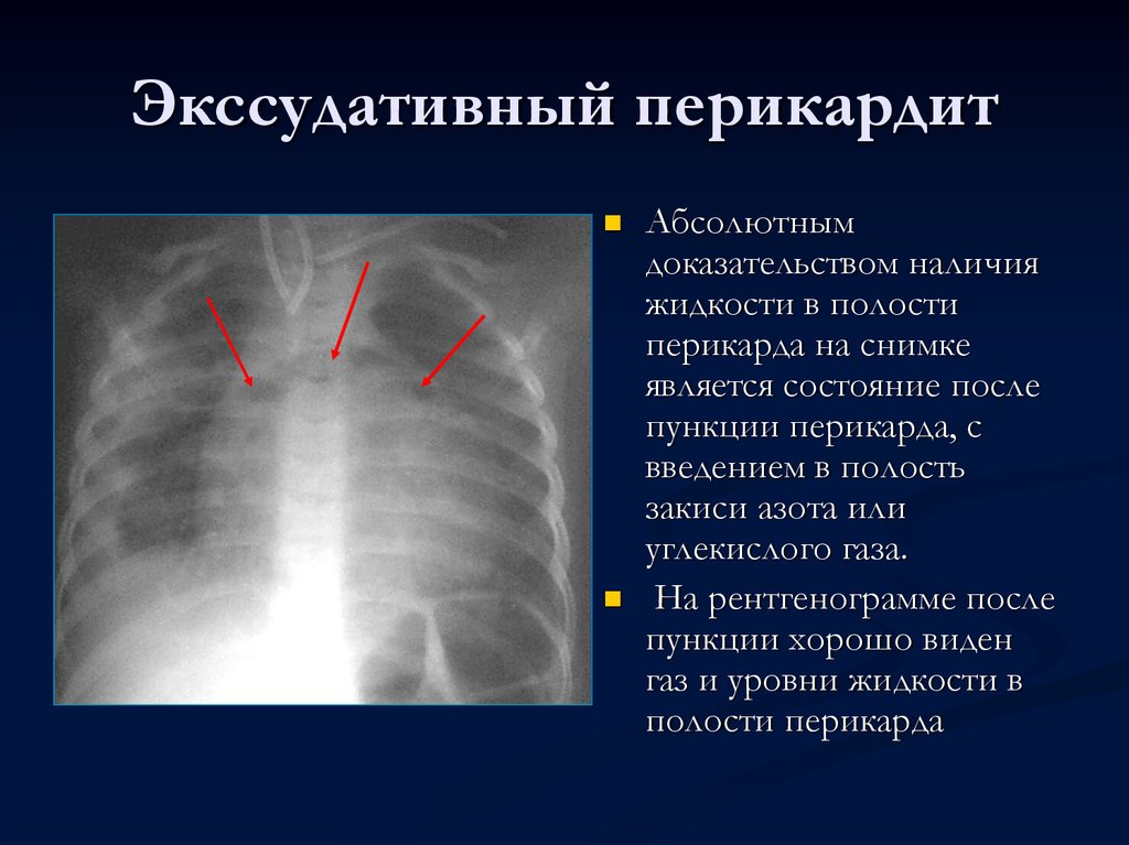 При выпотном перикардите на рентгенограмме наблюдается легочный рисунок тест ответ