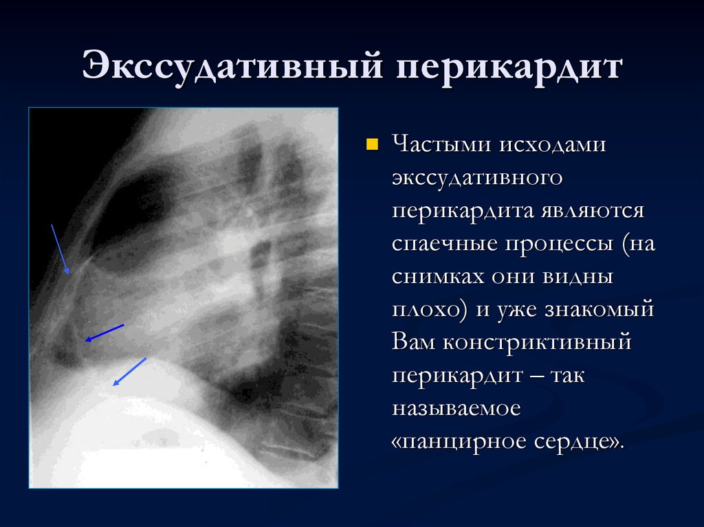 Туберкулезный перикардит презентация