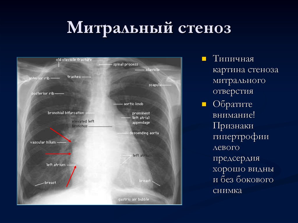Границы расширены влево. Стеноз митрального клапана рентген. Рентген при митральной недостаточности. Митральный стеноз рентген признаки. Стеноз митрального клапана рентген признаки.