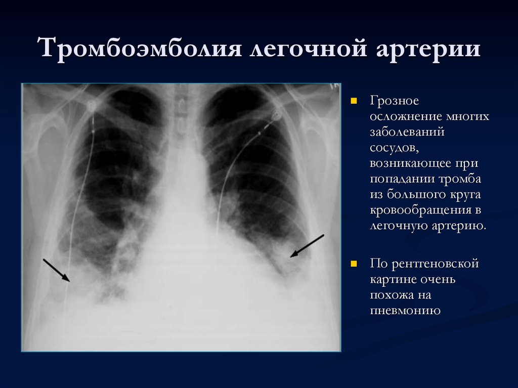 Тромбоэмболия сердечная. Рентгенография органов грудной клетки при Тэла. Инфаркт легкого при Тэла рентген. Тэла пневмония рентген.
