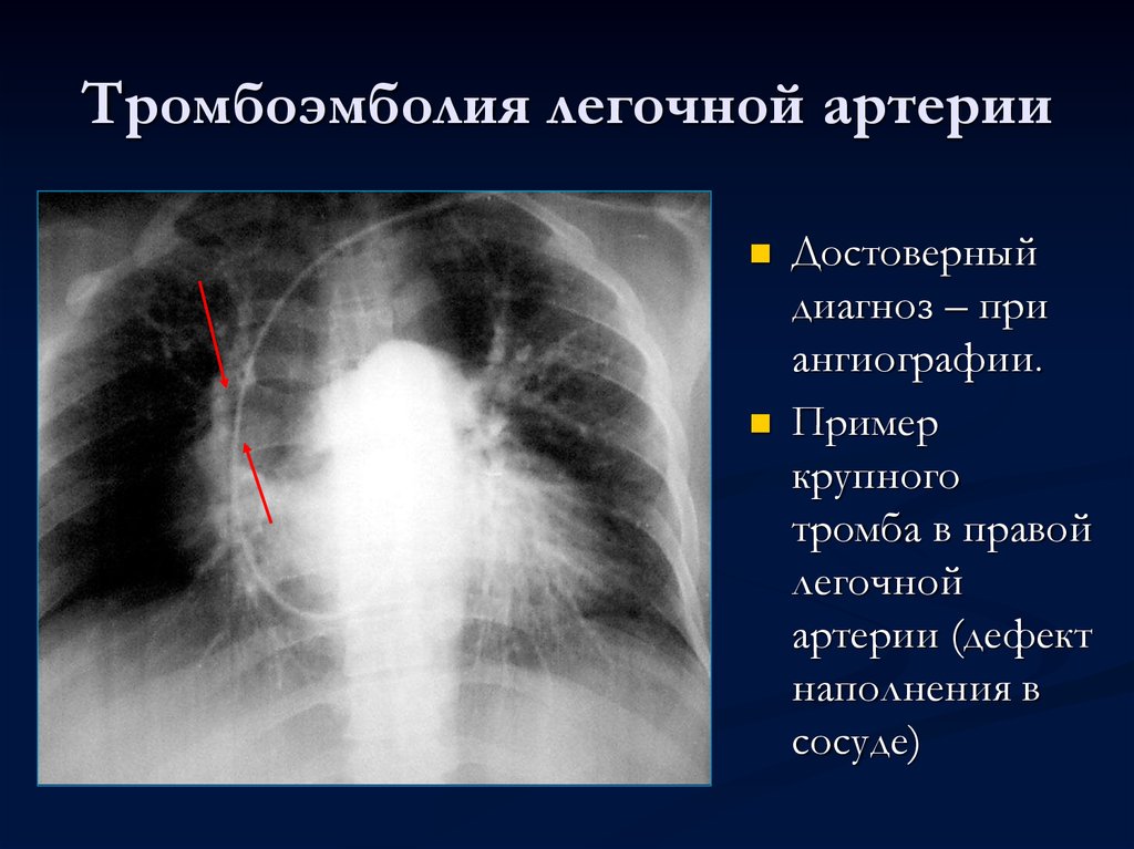 Острой тромбоэмболии легочной артерии
