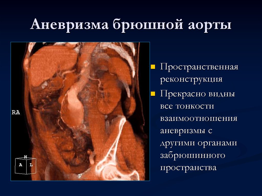 Аневризма брюшной аорты фото